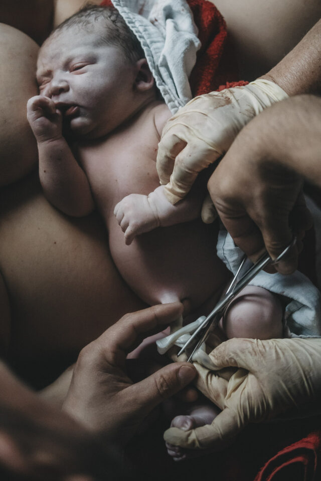Neugeborenes auf dem nackten Bauch der Mutter. Die Nabelschnur wird gerade abgetrennt.